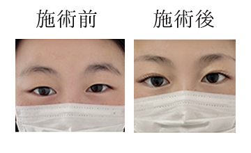 ROAK（ローク）施術例　まつげパーマ例1